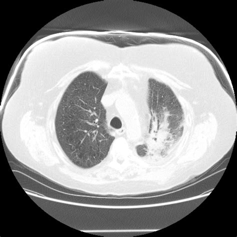 Radiation Induced Lung Injury Pulmonology Advisor