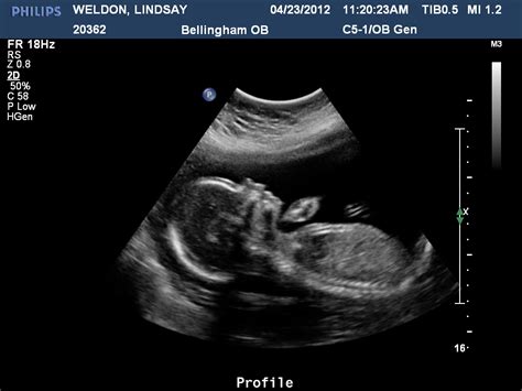 Mr And Mrs Weldon 20 Weeks Pregnant Means20 Week Ultrasound