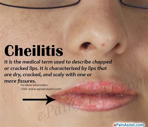 Angular Cheilitis Symptoms Sales Prices Save 45 Jlcatjgobmx