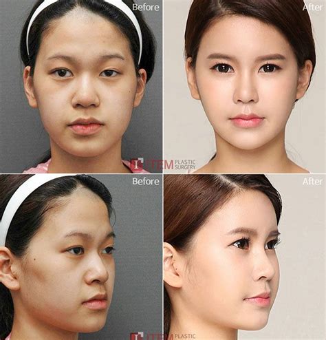 Korean Face Plastic Surgery Chin Lips And Nose Before And After