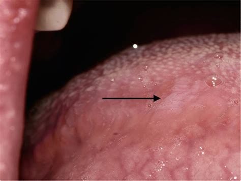 A Small Faint White Lesion With Prominent Vertical And Corrugated