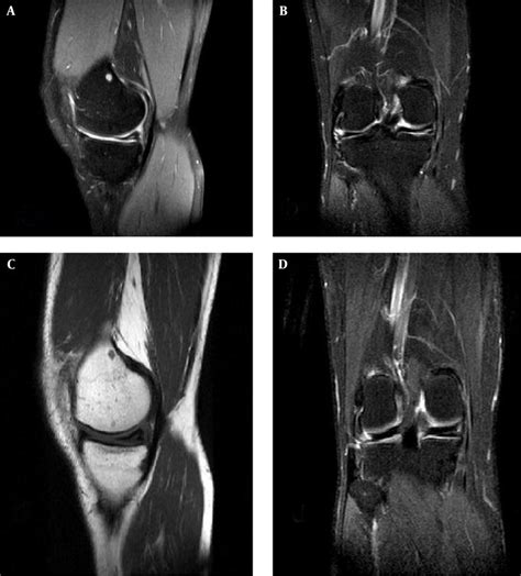 Mri Of A Horizontal Tear In Medial Meniscus A T Sagittal Image B My