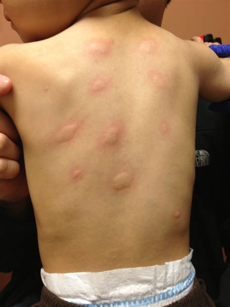 Egg allergy affects about 1.3 % of all children and 0.2 % of all adults. Egg Allergy | Belgium| PDF | PPT| Case Reports | Symptoms ...