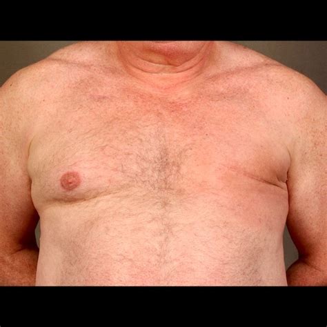 Male Mastectomy And Reconstruction NYBRA