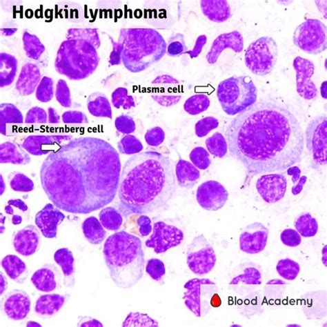 Hodgkin Lymphoma Blood Academy
