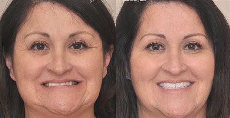 Cosmetic Dentistry Facial Profile Hot Nude Comments