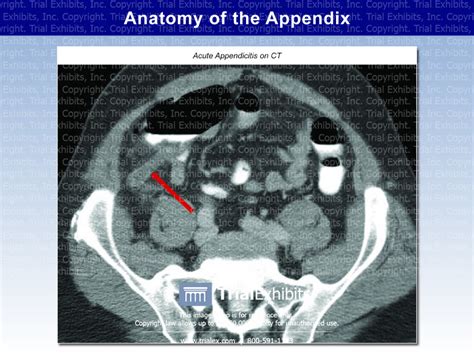 Anatomy Of The Appendix Acute Appendicitis On Ct Trial Exhibit