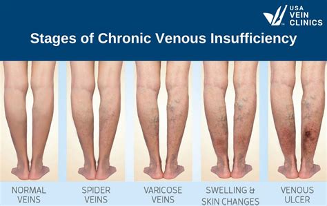 What Are The Chronic Venous Insufficiency Stages