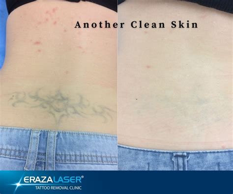 Tattoo Removal Images Before And After Erazalaser Clinics