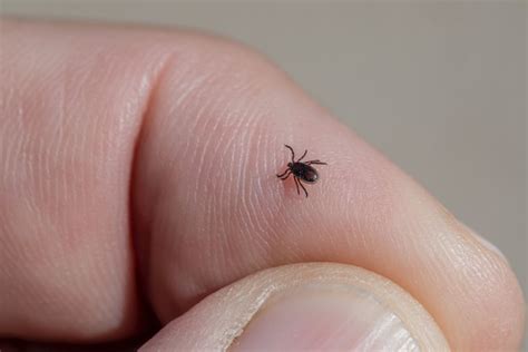Alpha Gal Syndrome A Meat Allergy Caused By Lone Star Ticks Is