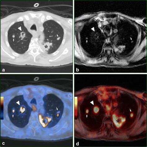 Comparison Of Petct And Petmri Of A Patient With Lung Cancer With