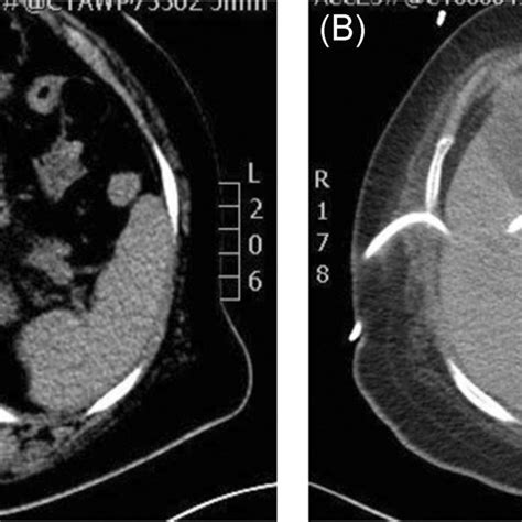 Computed Tomography Ct Scan Showing Severely Distended Gallbladder