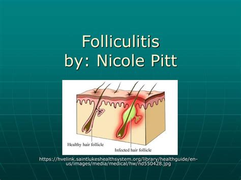 Ppt Folliculitis By Nicole Pitt Powerpoint Presentation Free