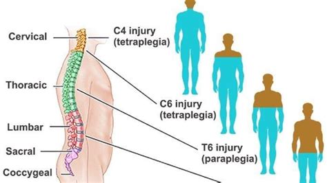 Getting To Know Spinal Cord Injury Causes Symptoms And Prevention