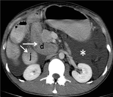 Axial Image Of Ct Abdomen With Intravenous And Oral Contrast