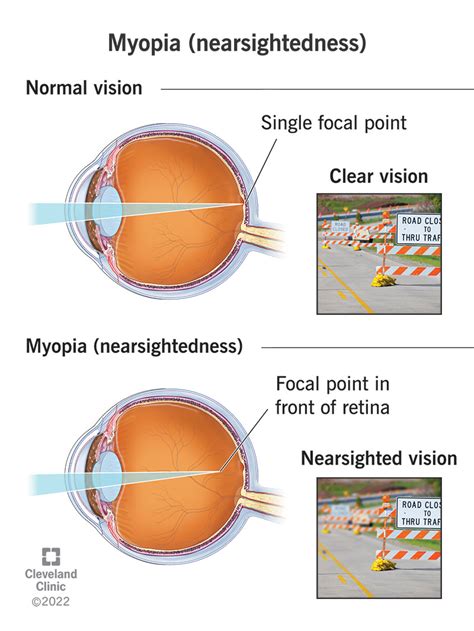 Myopia Nearsightedness Causes Symptoms Andtreatment
