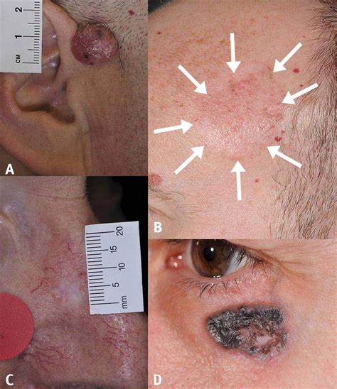Nodular Type Of Basal Cell Carcinoma According To Some