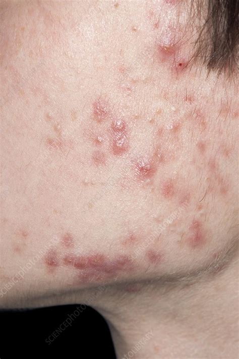 Acne Vulgaris Stock Image C0197773 Science Photo Library