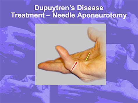 Dupuytrens Disease Hand Surgery Source