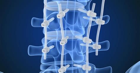 Posterior Lumbar Interbody Fusion Plif Scottsdale Az Orthopedic
