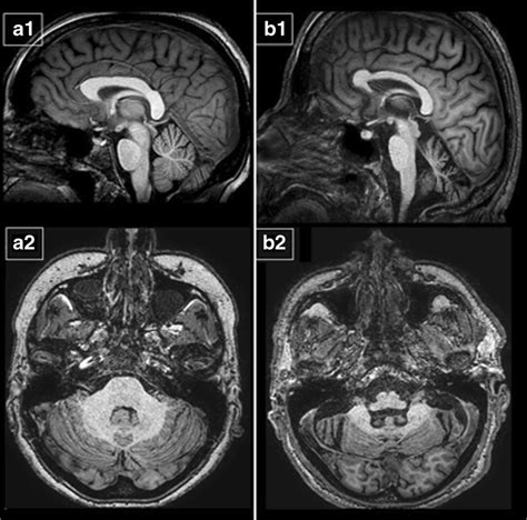 Brain Mri T1 Weighted Sagittal And Axial Images A1 A2 40 Years Old