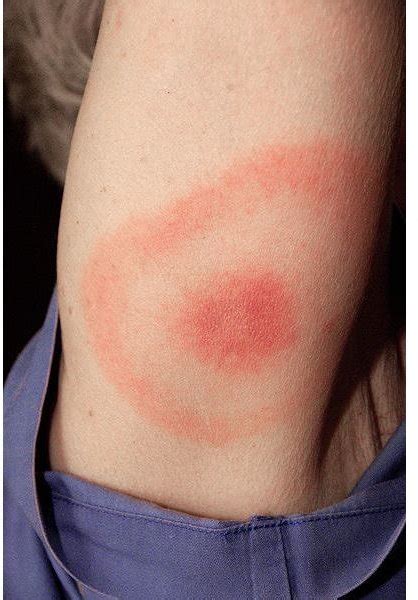 Bullseye Rash For Lyme Disease Health Guide Info