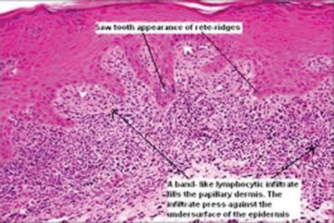 Histology Of Oral Lichen Planus Open I