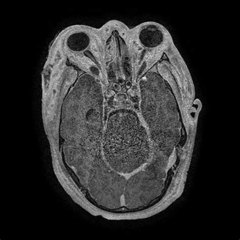 Axial T1 Weighted Magnetic Resonance Imaging With Gadolinium Contrast