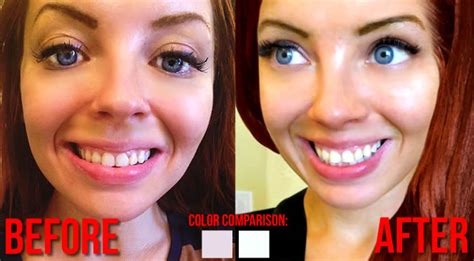 Teeth Whitening Before After Transformation 140 Giveaway