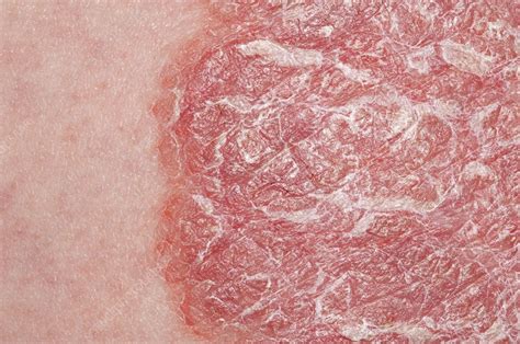 Plaque Psoriasis On The Skin Stock Image C0117474 Science Photo