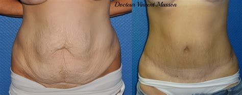 Une chirurgie réparatrice une chirurgie réparatrice. Chirurgie réparatrice des séquelles d'amaigrissement à ...