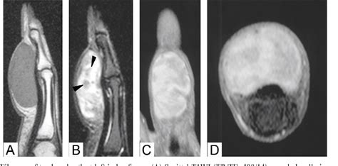 Figure 3 From Mri Findings Of Giant Cell Tumor Of Tendon Sheath And