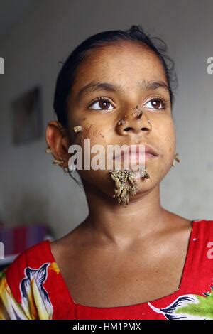 Dhaka Bangladesh févr Patient du Bangladesh Sahana Khatun pose pour une photo