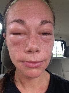 Read about anaphylaxis and how it differs from an allergic reaction. EXERCISE INDUCED ANAPHYLAXIS and the ER - PART 2 ...