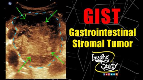 Gastrointestinal Stromal Tumor Gist Ultrasound Doppler Case 144 Youtube