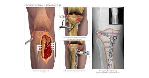 Orif Of Right Tibial Plateau Fracture High Impact® Visual Litigation