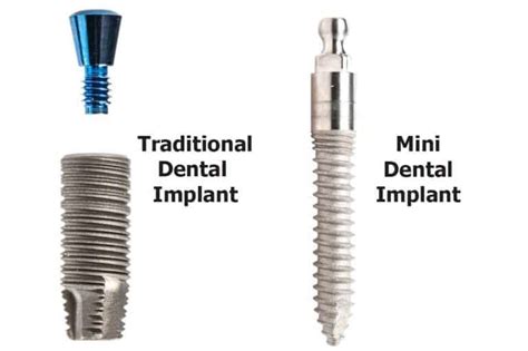 What Are Mini Dental Implants Cost Pros And Cons