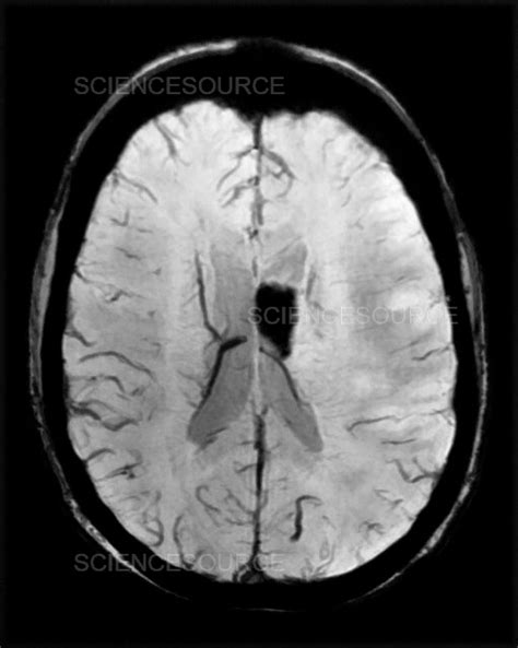 Hemorrhagic Mca Infarct Mri Stock Image Science Source Images