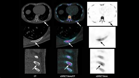 Differentiation Of A Rib Benign Lesion From A Metastasis Using Xspect Quant