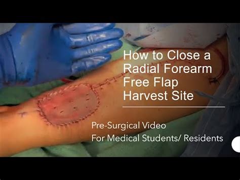 Surgical Closure Of Radial Forearm Free Flap Harvest Site Youtube