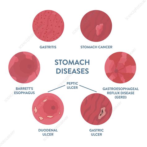 Stomach Diseases Illustration Stock Image F0336688 Science