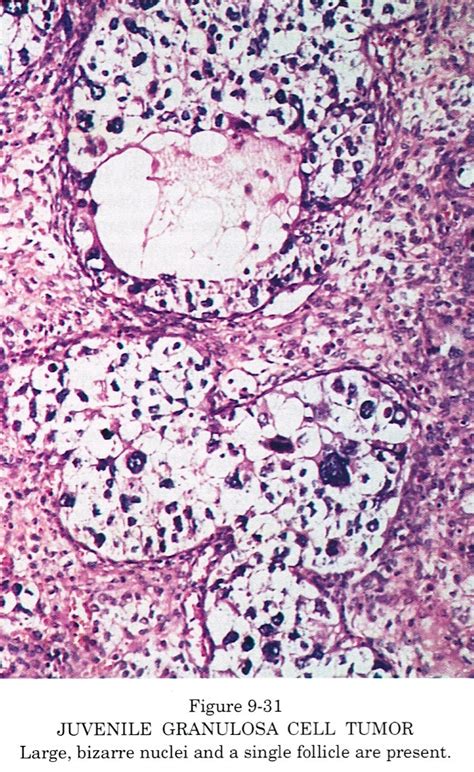 Pathology Outlines Granulosa Cell Tumor Juvenile