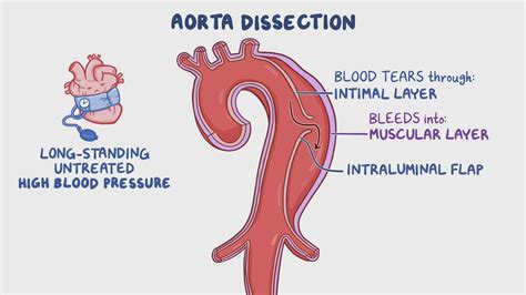 Aortic Dissection Clinical Sciences Osmosis Video Library