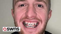 "I chose have braces in my 30s over Turkey teeth - I don't regret my decision"