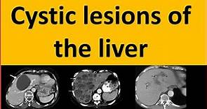 Differential diagnosis of cystic lesions of the liver