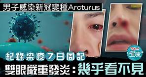 【變種病毒】男子疑染新冠變種Arcturus　雙眼嚴重發炎：幾乎看不見 - 香港經濟日報 - TOPick - 健康 - 醫生診症室