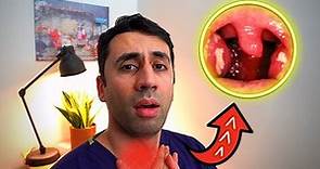 What Causes a Sore Throat? HOME Remedies and Cures for Fast TREATMENT| Doctor Explains