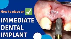 How is an IMMEDIATE DENTAL IMPLANT surgery done? #implants