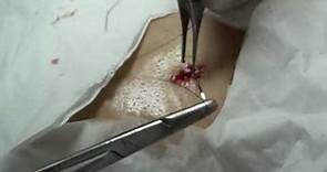 切除黑痣, 切除墨痣 (術後縫線) ( Part 2 ) Dr Chung King Lueh excision biopsy of skin lump
