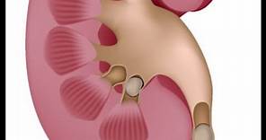 Kidney Stones with Urologist Dr. Scott Davidson